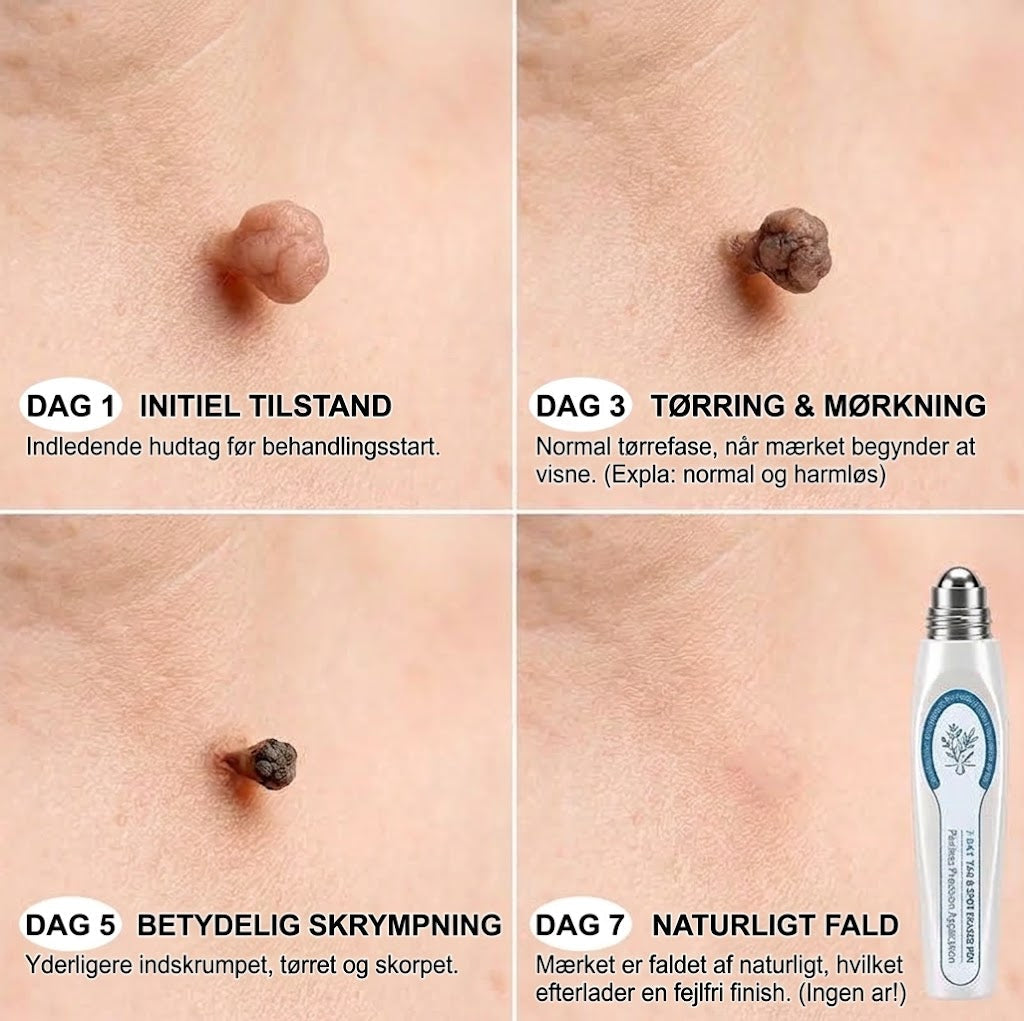 HudRoll™ Serum mod vorter og hudforandringer