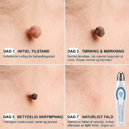 HudRoll™ Serum mod vorter og hudforandringer